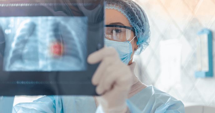 Tecnología artificial permitiría detección del cáncer pulmonar un año antes de lo habitual