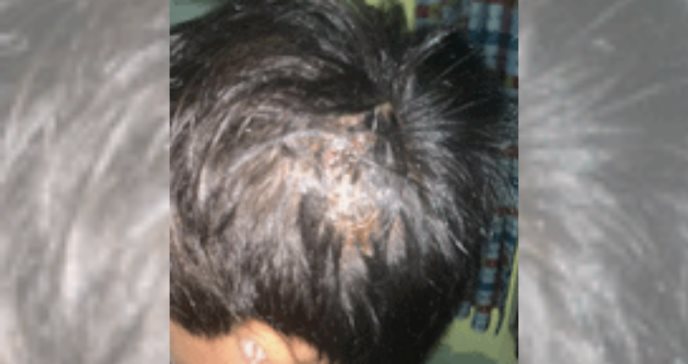 Dermatitis seborreica culmina con peligrosa infección de hongo en paciente pediátrico