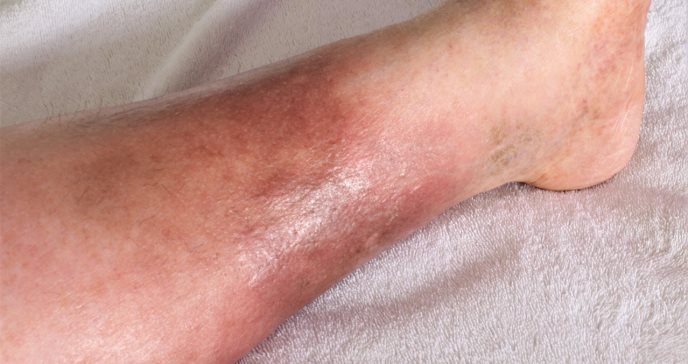 Hinchazón y enrojecimiento de la pierna: síntomas de la trombosis venosa