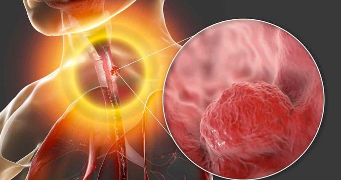Tratamiento contra el reflujo reduce el cáncer de esófago