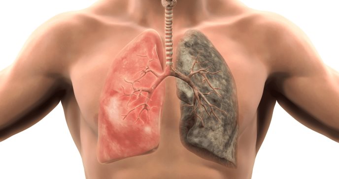 Test sanguíneo detecta de forma precisa un tipo de cáncer de pulmón en fase inicial