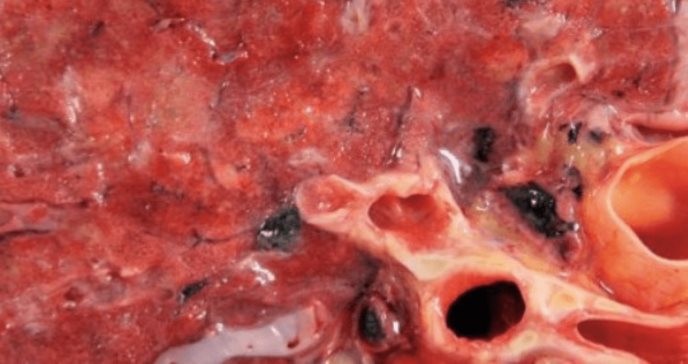 Autopsias pulmonares de pacientes con Covid-19 revelan pistas sobre su tratamiento