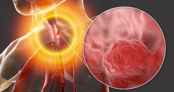 Novedoso uso de la citoesponja sirve para detectar esófago de Barrett y cáncer
