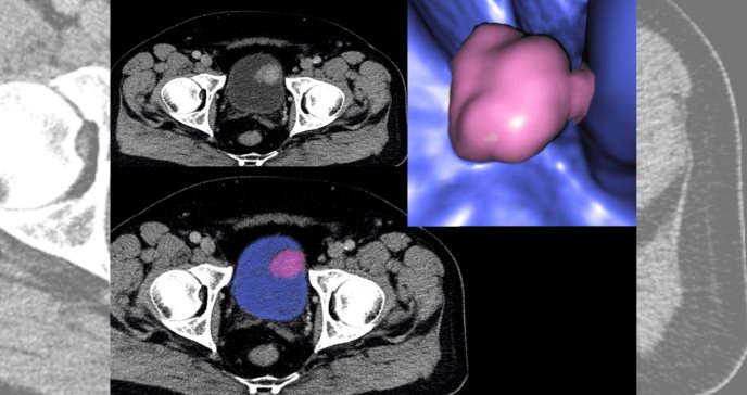 Quimioterapia complementaria mejora supervivencia en pacientes con cáncer de vejiga con invasión muscular
