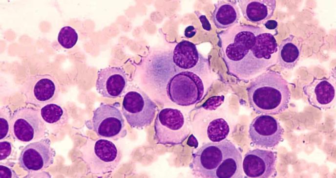 El régimen de tripletes aumenta la supervivencia en el melanoma metastásico