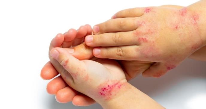 FDA aprueba upadacitinib para tratar a adultos y niños de 12 años o más con dermatitis atópica