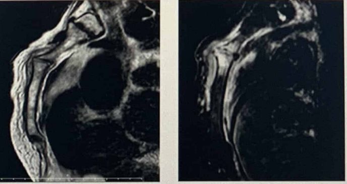 Hallan rara complicación de artritis séptica y osteomielitis en articulación del esternón en Puerto Rico 
