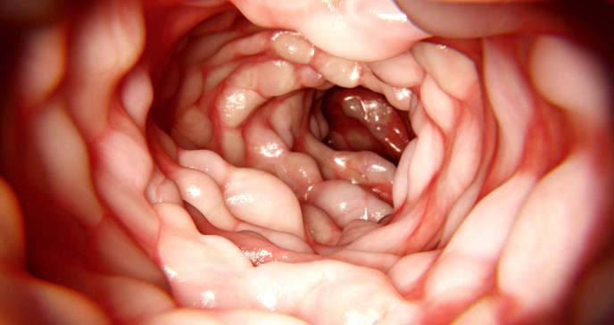 Dieta de exclusión en enfermedad de Crohn lograría remisión leve o moderada, según estudio