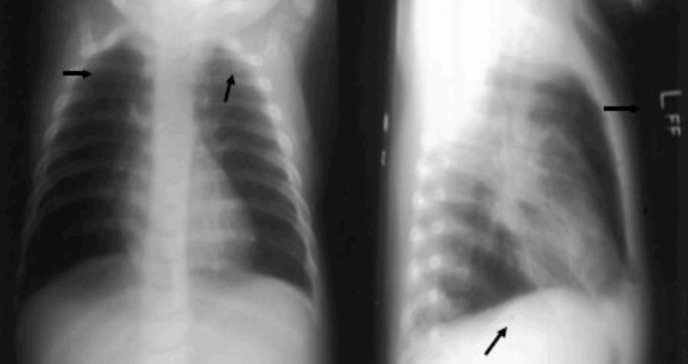 El diagnóstico precoz de las bronquiectasias es fundamental en el asma grave tipo 2