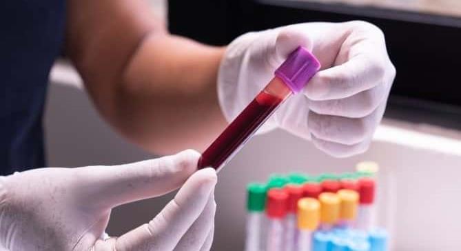 Reducción de las pruebas del VIH durante la pandemia aumentan las preocupaciones sobre la transmisión