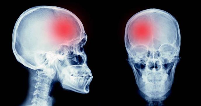 Existe un alto riesgo de epilepsia 1 año después del accidente cerebrovascular, según estudio