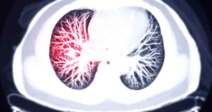 Método diagnóstico para tromboembolia pulmonar reduce la necesidad de estudios de imagen