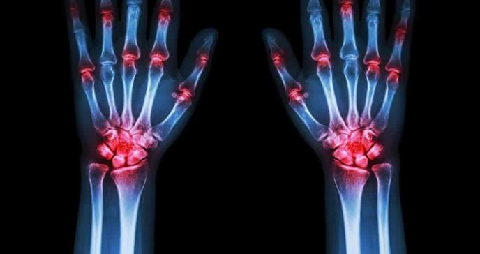 Estudio confirma la eficacia de Guselkumab en pacientes con artritis psoriásica