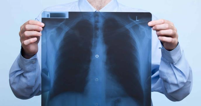Umbrales de dímero D descartan tromboembolia pulmonar, según estudio