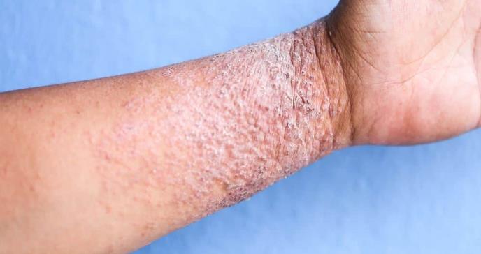 La FDA aprobó el Tralokinumab para adultos con dermatitis atópica de moderada a grave