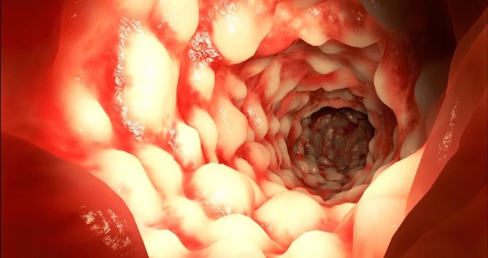 Las estenosis de Crohn pueden responder a la terapia con medicamentos inmunosupresores, según estudio
