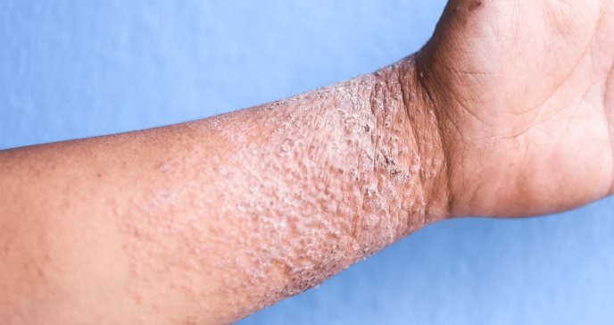 Identifican 11 variantes raras relacionadas con la dermatitis atópica