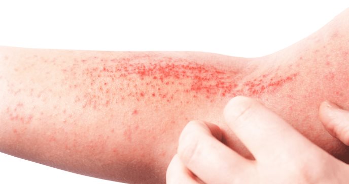 La dermatitis atópica se asocia a un mayor riesgo de enfermedades autoinmunes