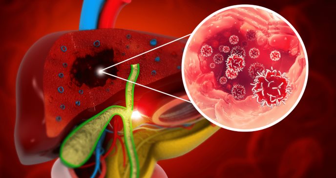 Investigadores identifican el mecanismo causal de la cirrosis hepática