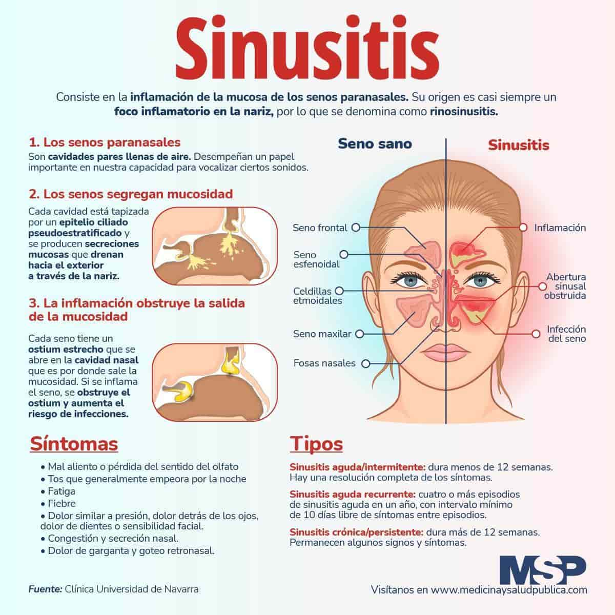 Todo Lo Que Necesitas Saber Sobre La Sinusitis Y Sus