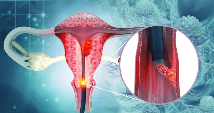 Estudio demuestra combinación de drogas con quimioterapia redujo la progresión de cáncer de endometrio
