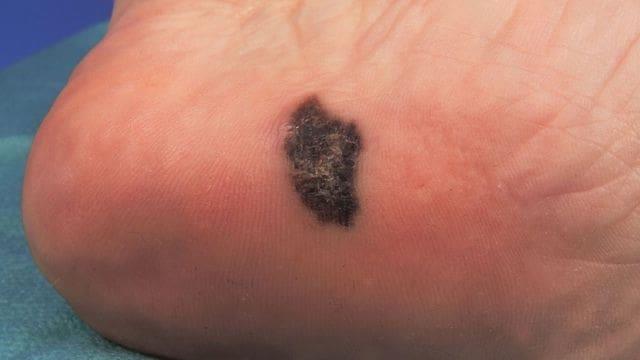 El melanoma lentiginoso acral y su relación con la presión