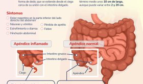 Apendicitis - Infografía