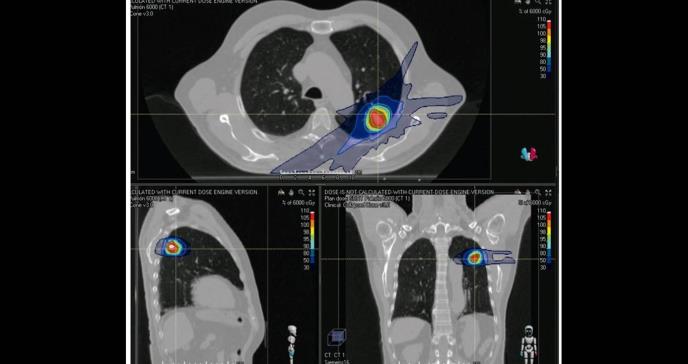 Mínima la utilización de radioterapia paliativa en pacientes con cáncer de pulmón en la Isla