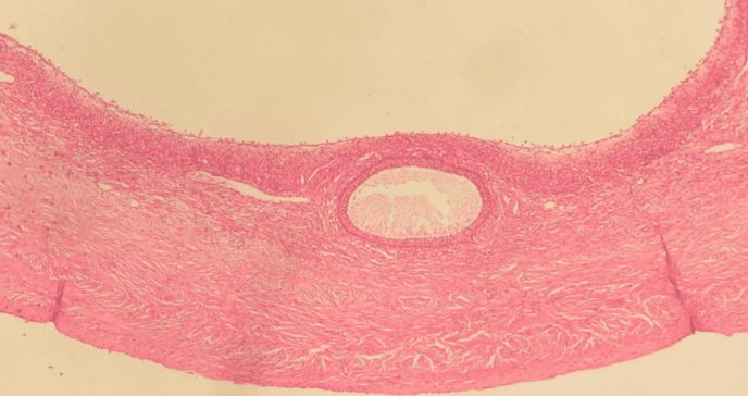 Hallan cistoadenoma seroso gigante en ovario accesorio en niña con obesidad mórbida