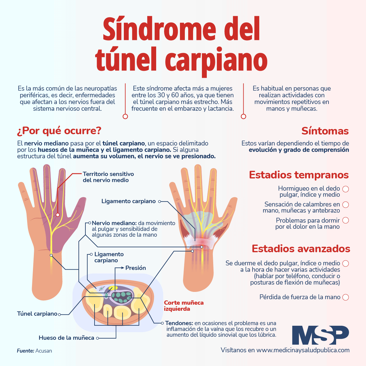 Diagnóstico y tratamiento del Síndrome del Túnel Carpiano.