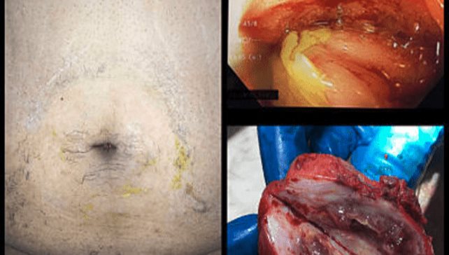 Severe Ulcerative Colitis-Like Pattern of Segmental Colitis With Diverticulosis