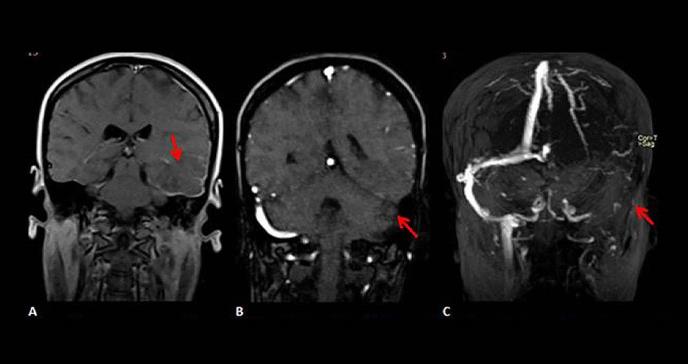 Paciente joven desarrolla una anomia reversible como complicación de una trombosis venosa cerebral