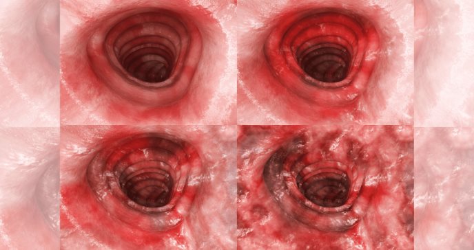 Estudio confirma perfil de seguridad de ozanimod en pacientes con colitis ulcerosa de moderada a grave