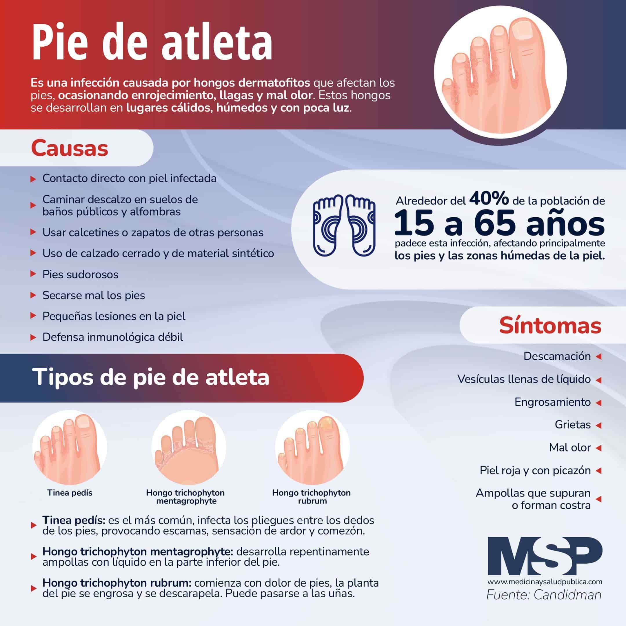 Pie De Atleta Infografía 0123