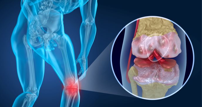 Subir de peso puede empeorar los síntomas óseos en pacientes con artrosis de rodilla.
