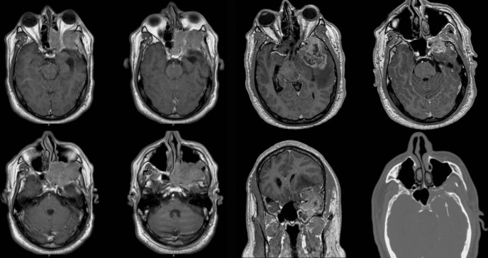 Inusual tumor de cerebro se registra en paciente puertorriqueño