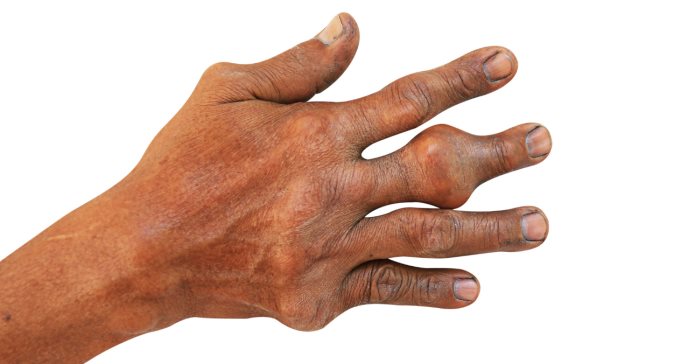 Todo lo que debes saber sobre la artritis séptica