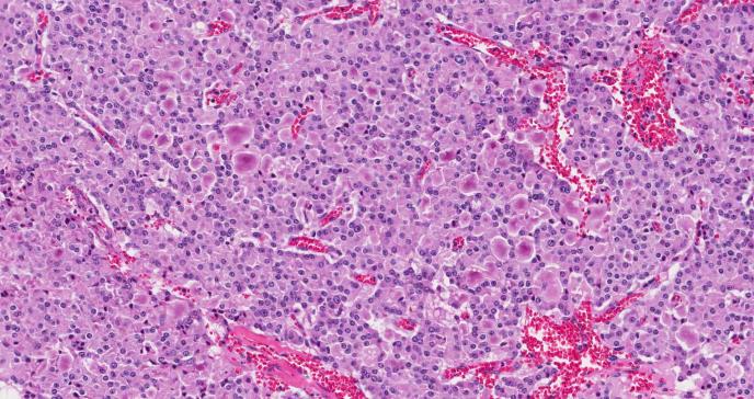Síntomas del cáncer de páncreas: causas y tratamiento
