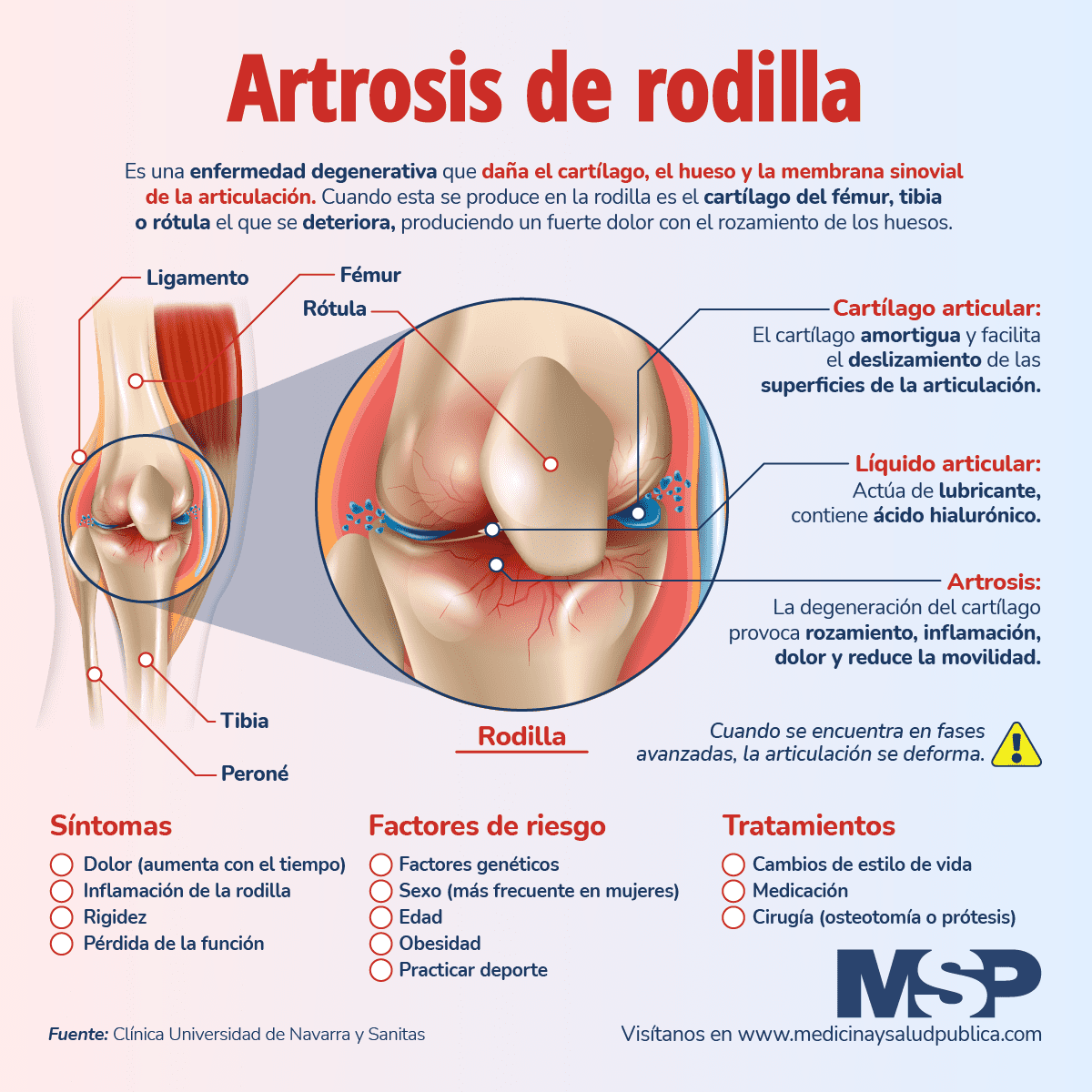 Tratamiento para la Artrosis de Rodilla