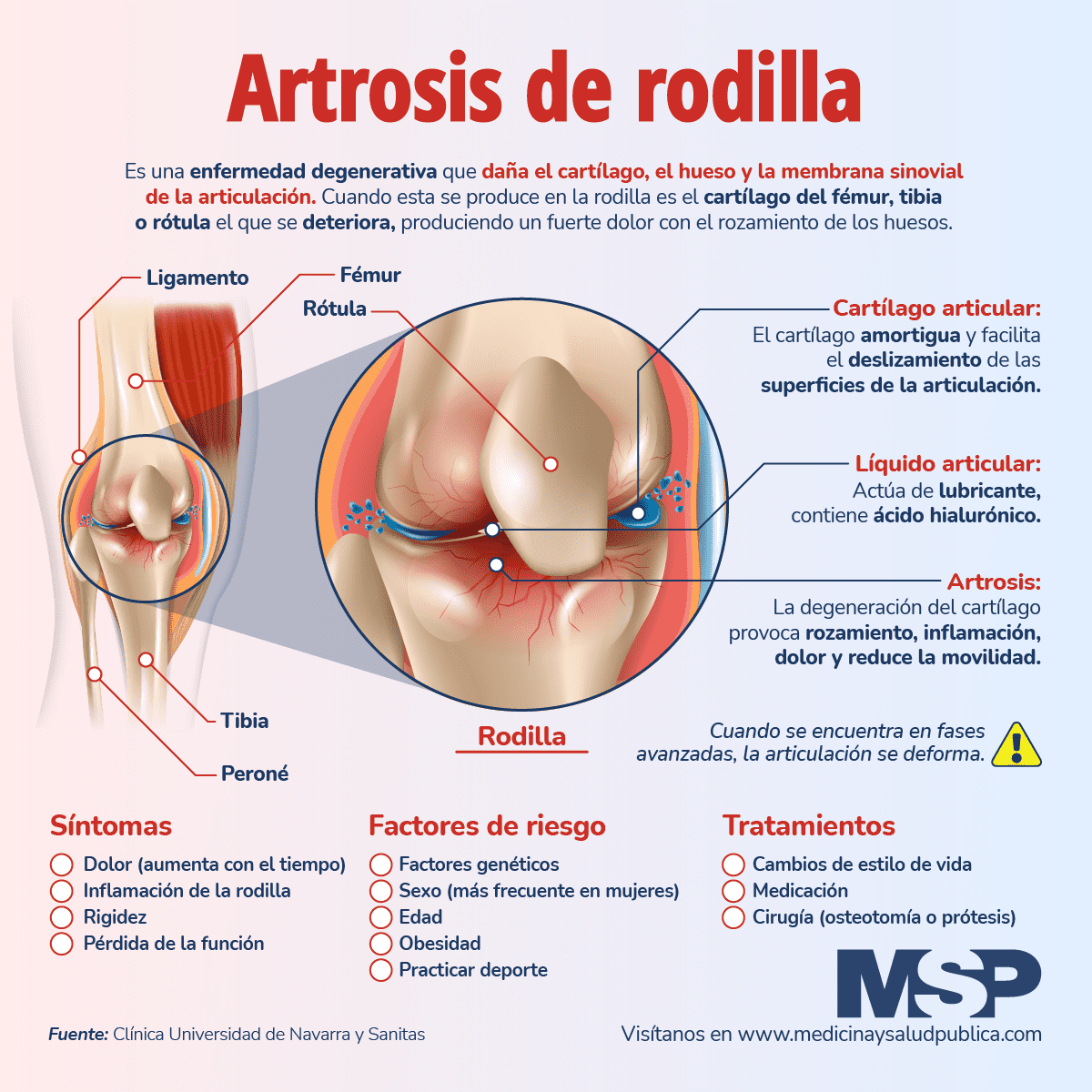 Artritis De Rodilla Infograf A