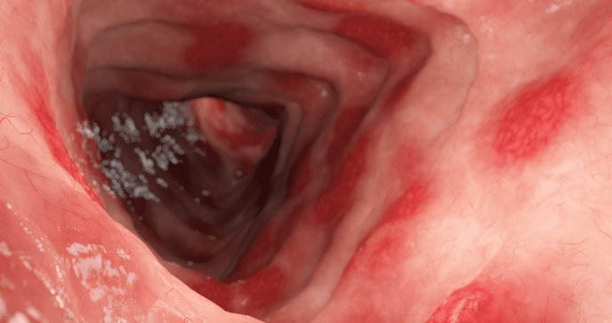 Estudio: Upadacitinib reduce las manifestaciones extraintestinales de la colitis ulcerosa