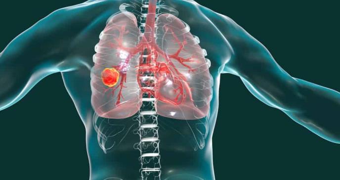 Síntomas del cáncer de pulmón, uno de los tumores más mortales
