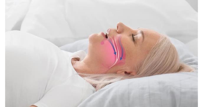 La apnea del sueño podría aumentar el dolor articular y la fatiga en mujeres mayores