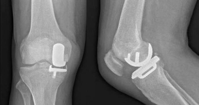 Diferencias genéticas ayudan a explicar por qué la artrosis de rodilla afecta más a las mujeres