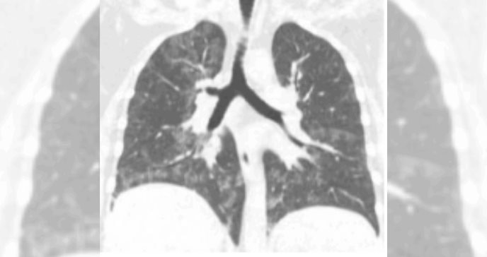 "Pulmones Grasos": raro caso de proteinosis alveolar pulmonar en Puerto Rico