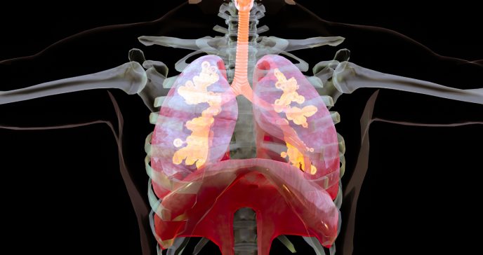 Qué se sabe de la sarcoidosis: una enfermedad rara e inflamatoria que afecta a los pulmones