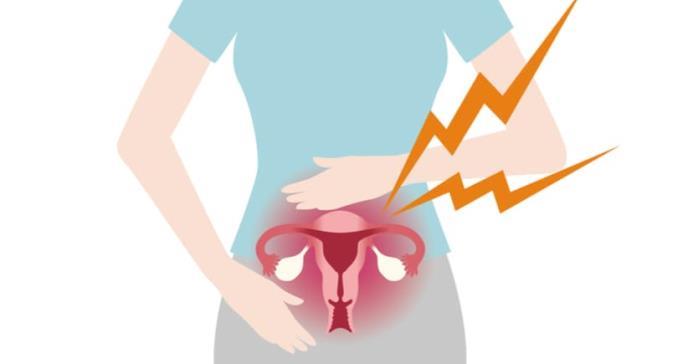 Histerectomía: ¿En qué casos es necesario extirpar el útero?
