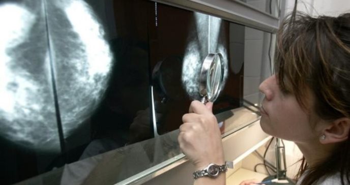 Las mamografías detectaría el riesgo cardiovascular, según investigación