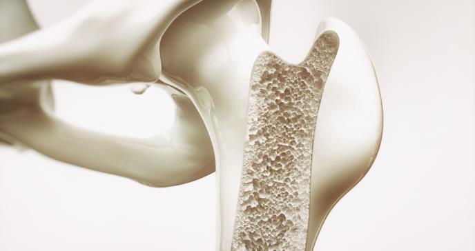 La terapia hormonal podría seguir teniendo un papel en el tratamiento de la osteoporosis
