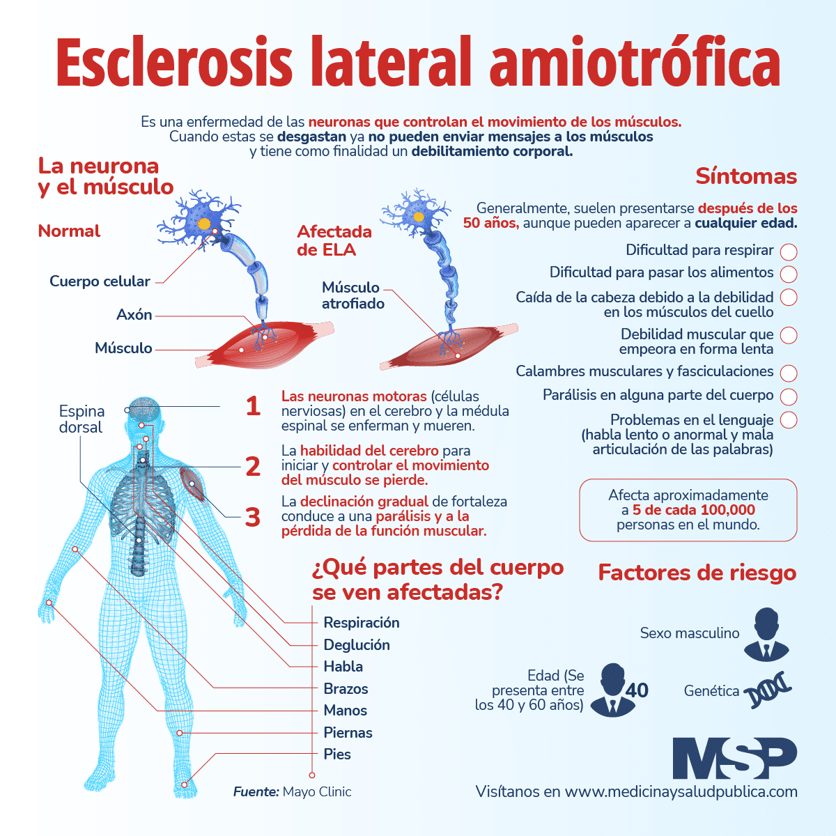 Esclerosis Lateral Amiotrófica ¿qué Es Y Cuáles Son Los Síntomas Revista Salud Coomeva